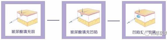 进口玻尿酸全脸填充