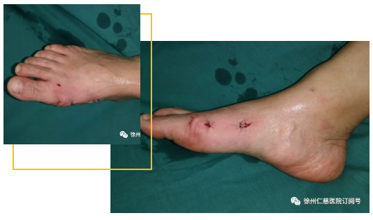 betway在线登陆足踝