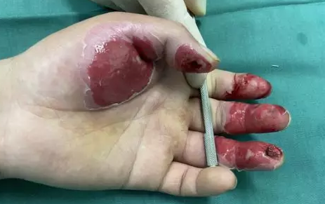 betway在线登陆烧伤科