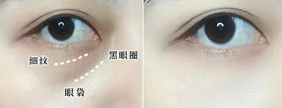 黑眼圈
