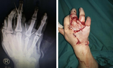 betway在线登陆手外科