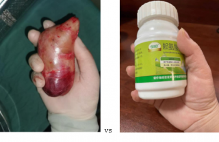 又遇到一个锁骨下长瘤子的患者,这种病要注意了!