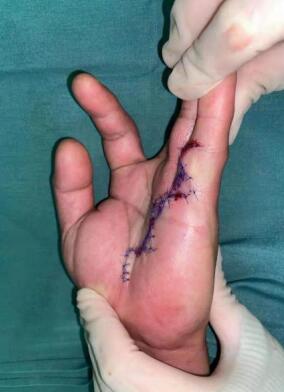 右手掌腱膜挛缩