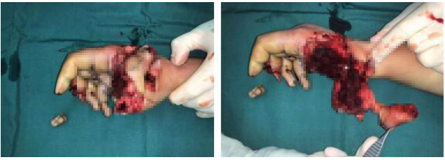 12月报道的自制飞天炮儿童伤情