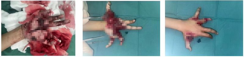 左手炸伤术前情况