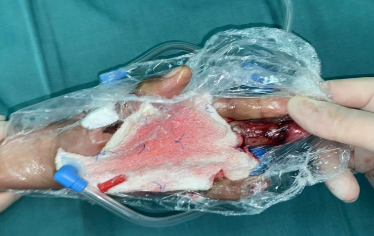 二次手术术后即刻