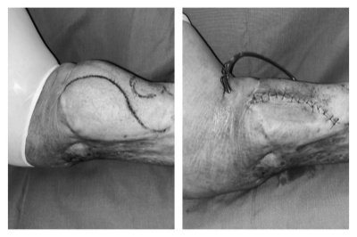 小曲足踝部位手术前后对比