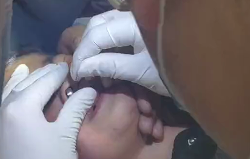 鼻孔异物-sararz口腔科