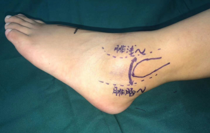 betway在线登陆足踝