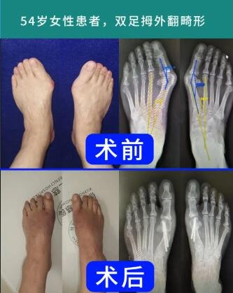 betway在线登陆拇外翻