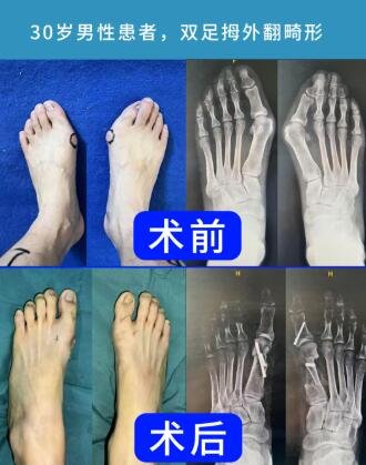 betway在线登陆拇外翻